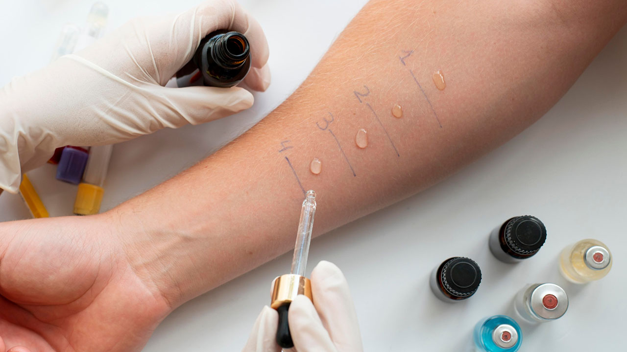 Allergy Testing