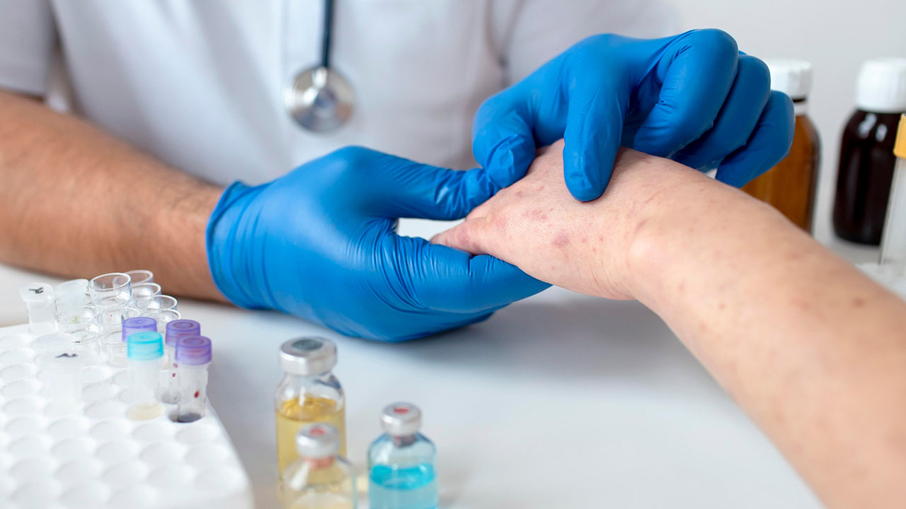 Anaphylaxis