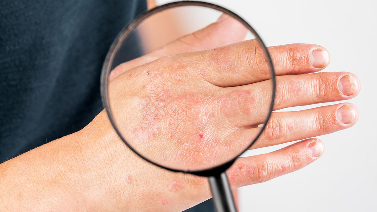 Contact Dermatitis