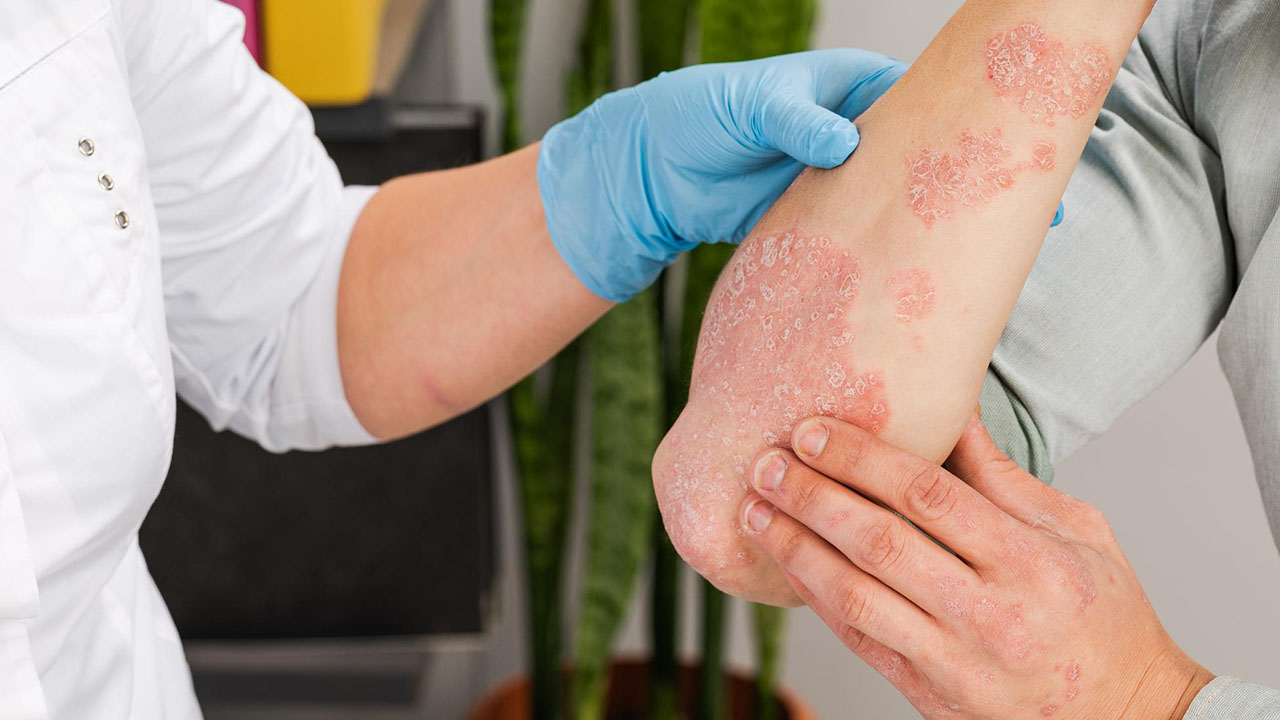 Atopic Dermatitis (Eczema)
