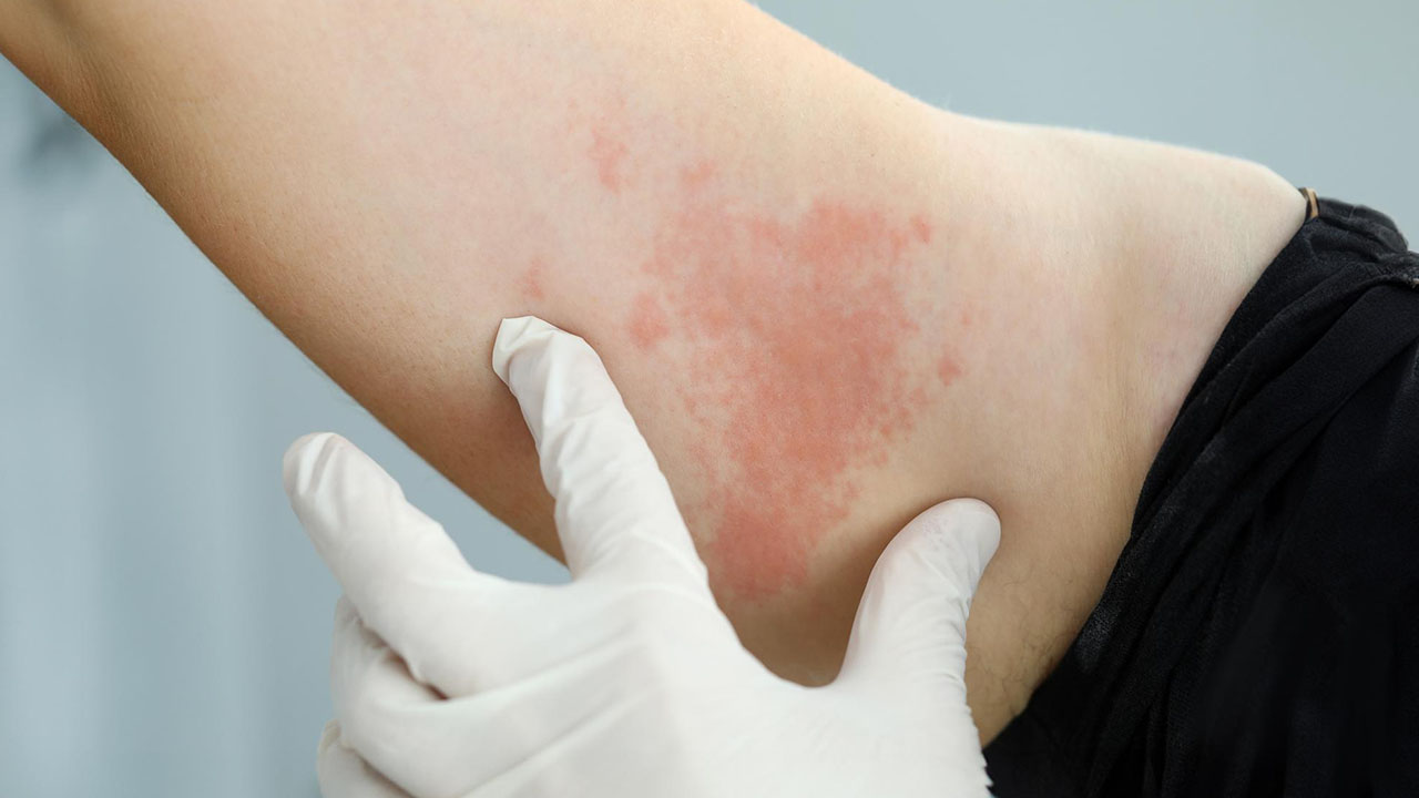 Urticaria (Hives)